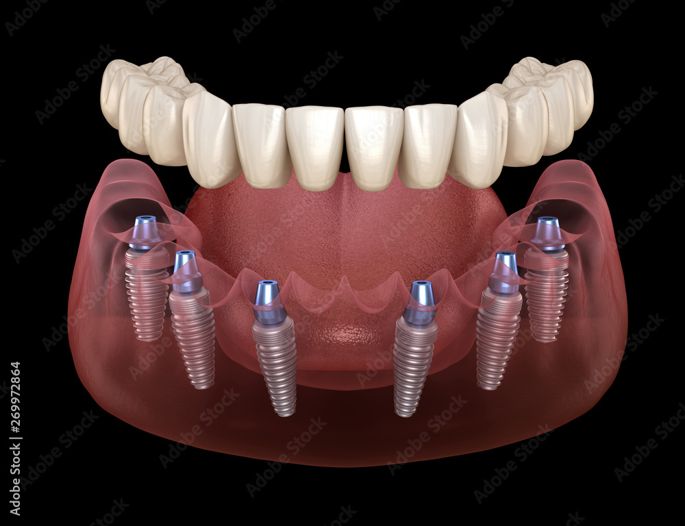 all-on-6-six-implant